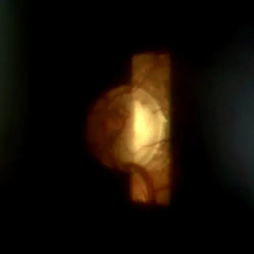 glaucoma (2)
