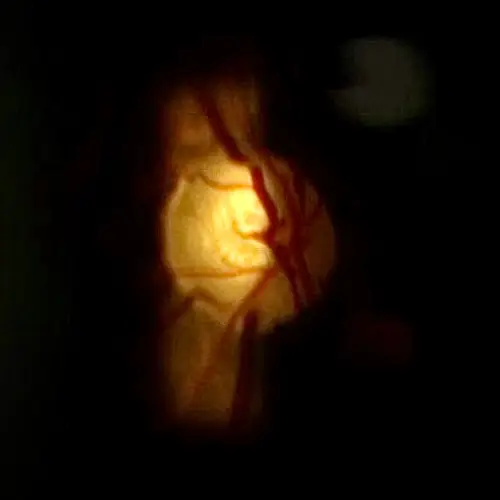 glaucoma (3)